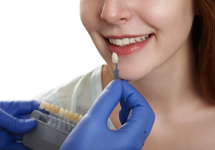 Tooth Coloured Restorations