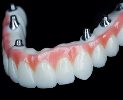 All-on-4 Implant Prosthesis