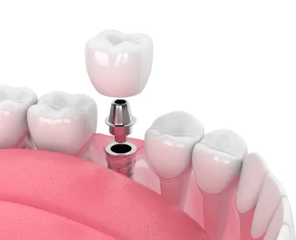 Implant Bridge