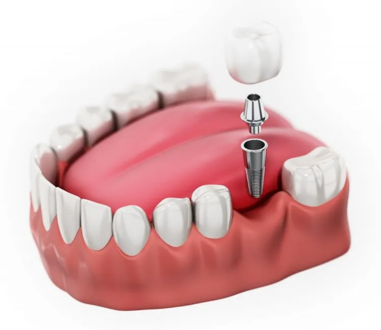 Dental Implants