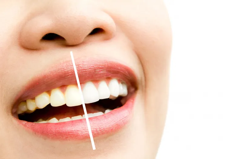 In-Clinic Whitening