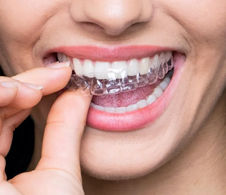 Clear Invisible Braces (Aligners)