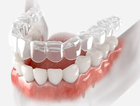 Custom Aligner Fabrication