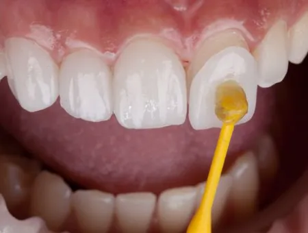Dental Veneers