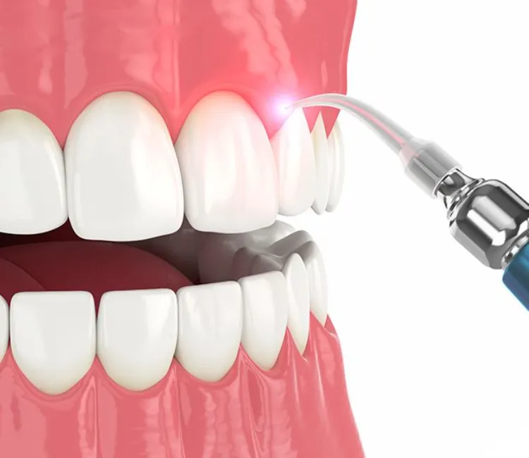Gum Depigmentation