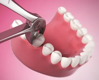 Impacted Wisdom Tooth Removal
