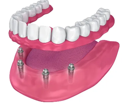 Implant Overdenture