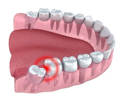 Lower Wisdom Tooth Extraction