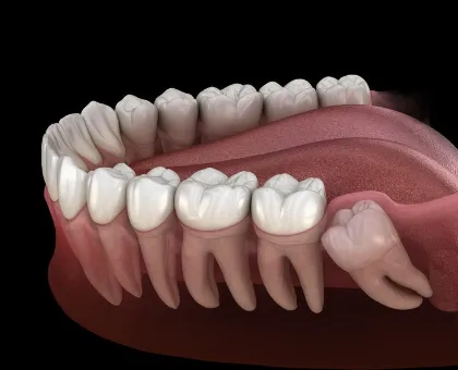 Preventive Wisdom Tooth Extraction
