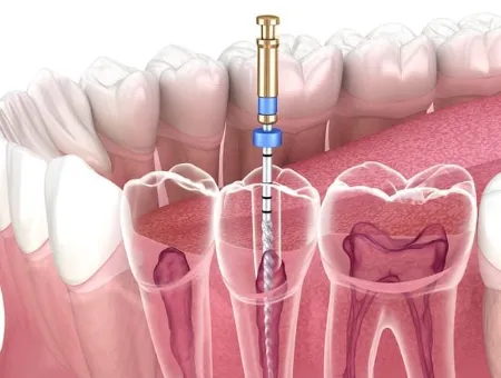 Re-treatment RCT
