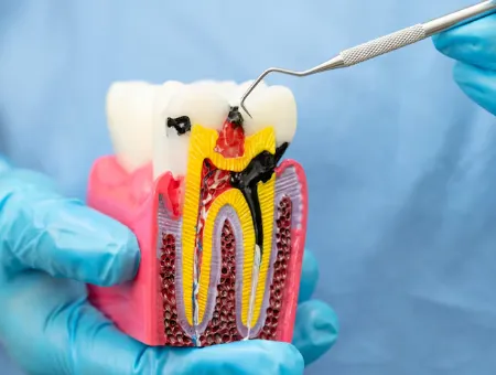 Root Canal Treatment