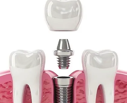 Single Tooth Implant