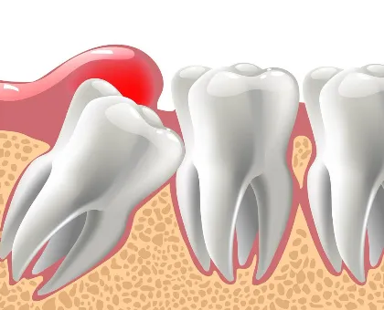 Upper Wisdom Tooth Extraction