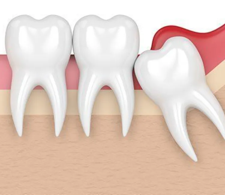 Wisdom tooth extraction